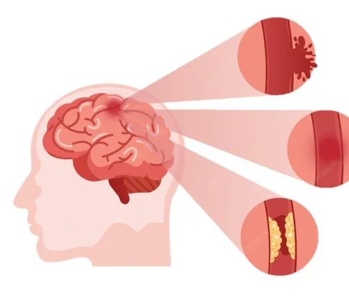 Accidente Cerebrovascular