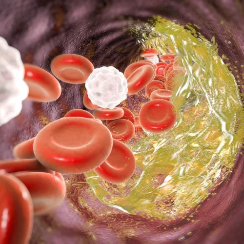 Enfermedad arterial coronaria