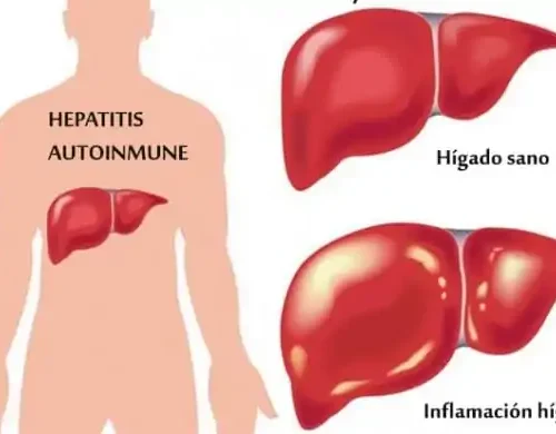 hepatitis-autoinmune Hepatitis autoinmune